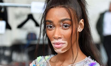what is wrong with winnie harlow's skin